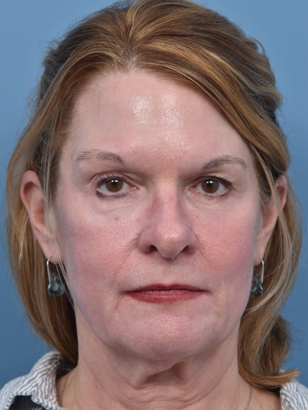 Rhinoplasty Before & After