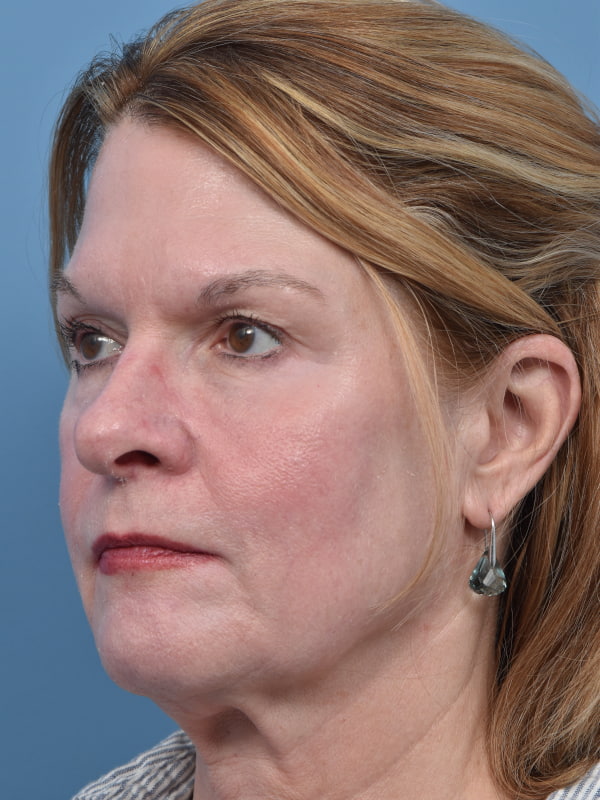 Rhinoplasty Before & After