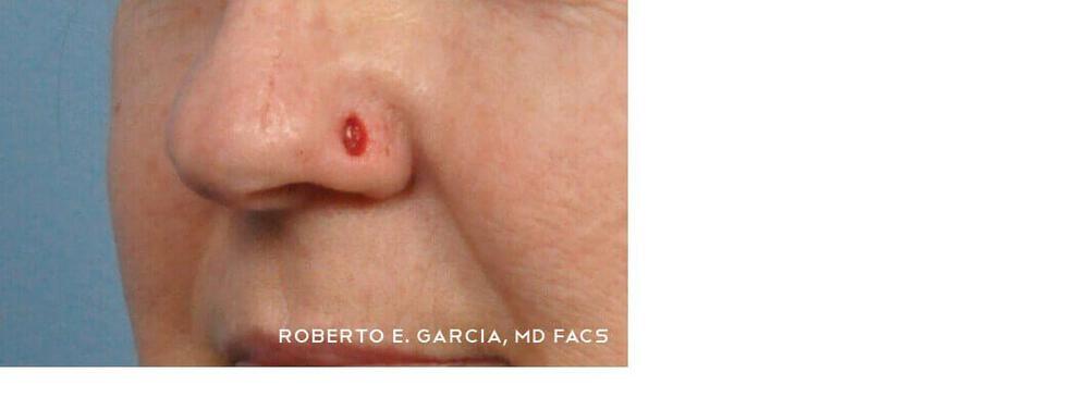Skin Cancer Excision Before & After
