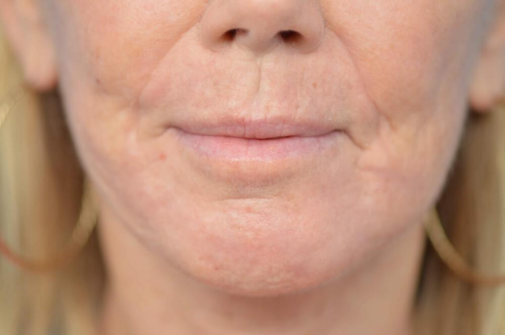 Chemical Peel Before & After