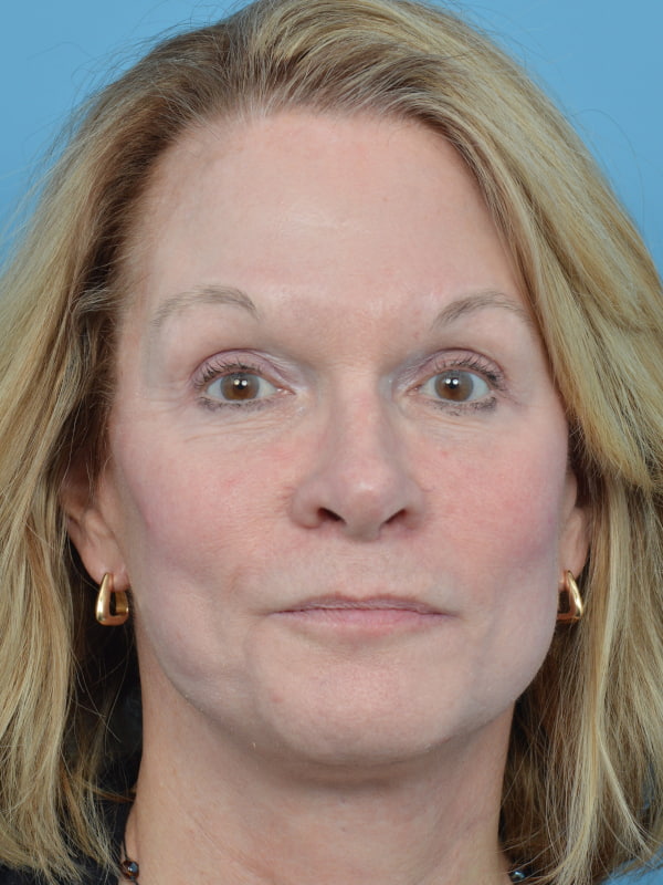 Chemical Peel Before & After