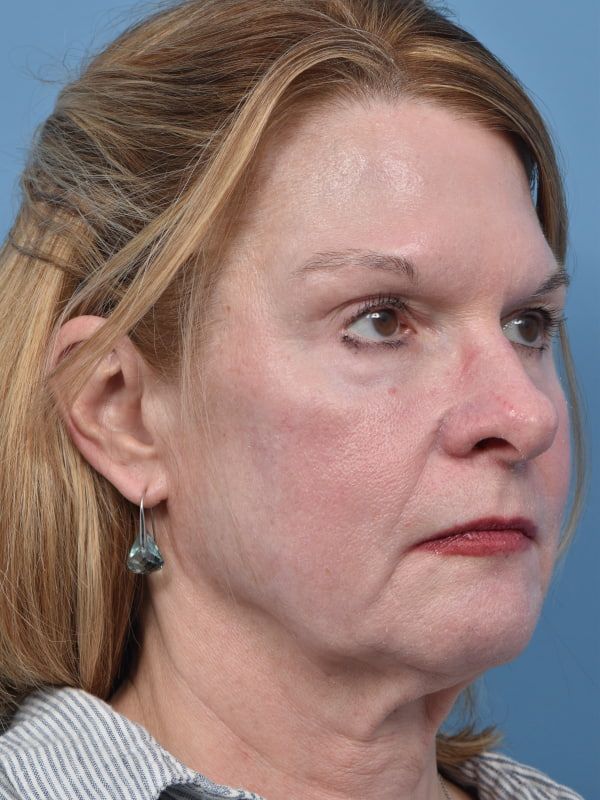 Chemical Peel Before & After