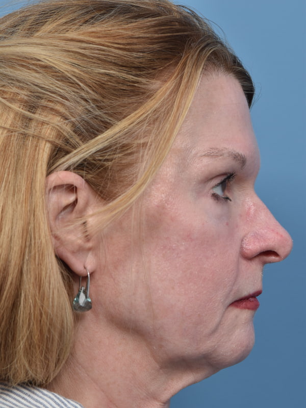 Chemical Peel Before & After