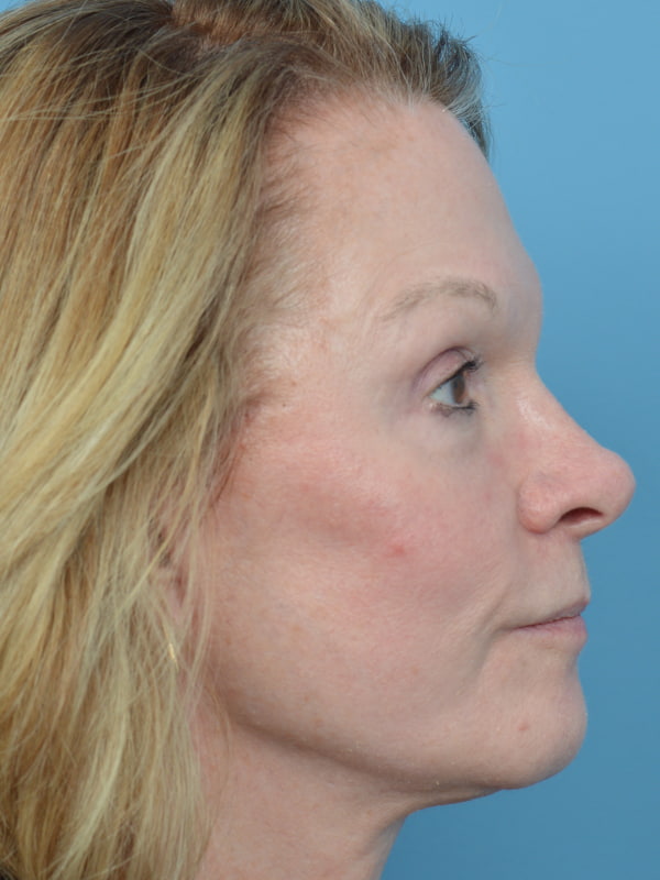 Chemical Peel Before & After